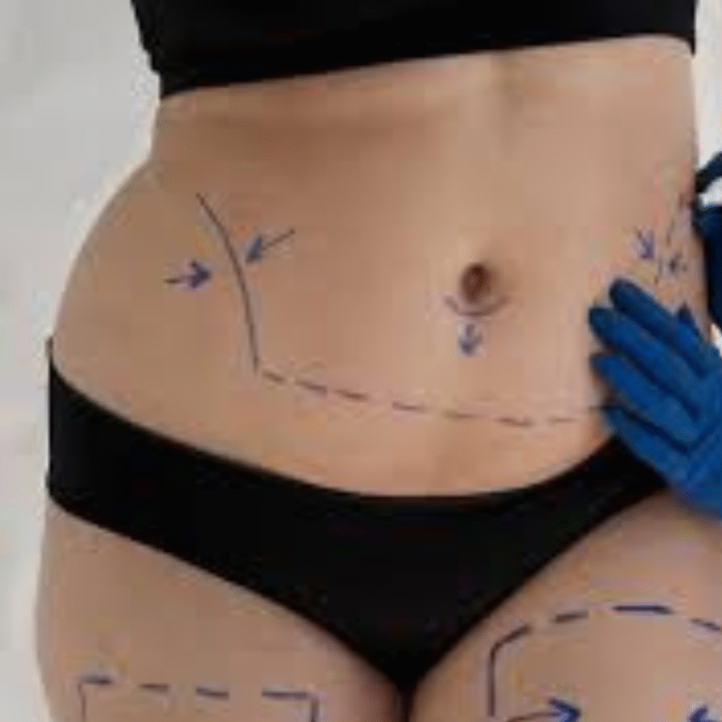 affordable abdominoplasty surgery in Turkey