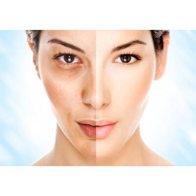Morpheus 8 for Acne Scars: Dubai’s Latest Solution for Clearer Skin