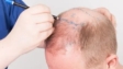 Natural Hair Restoration with Advanced Techniques