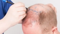 Natural Hair Restoration with Advanced Techniques