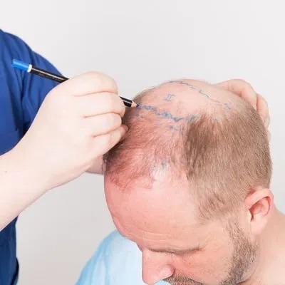 Natural Hair Restoration with Advanced Techniques