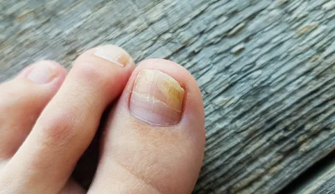 Common Signs of Fungal Nail Infections Edinburgh Today